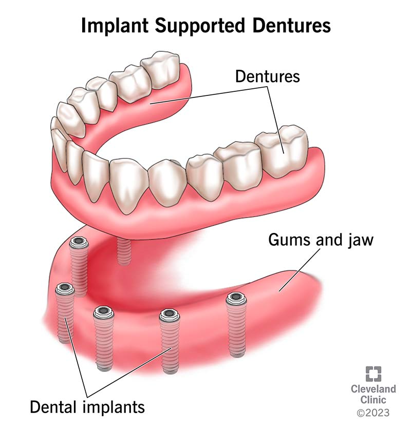Dentures & Overdentures