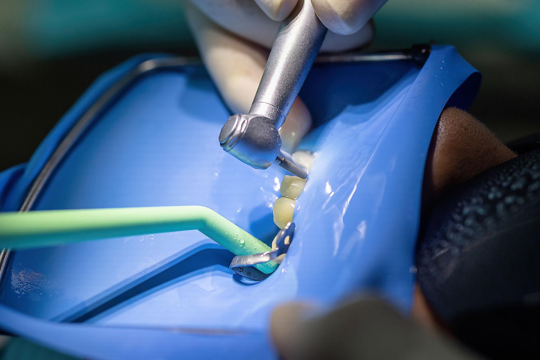 Root Canal
